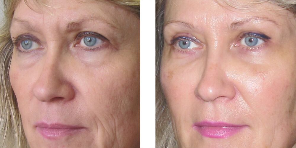 Avant / Après Lipofilling du visage