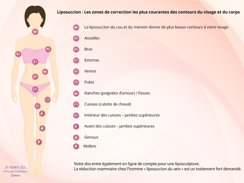 Liposuccion Les zones de correction