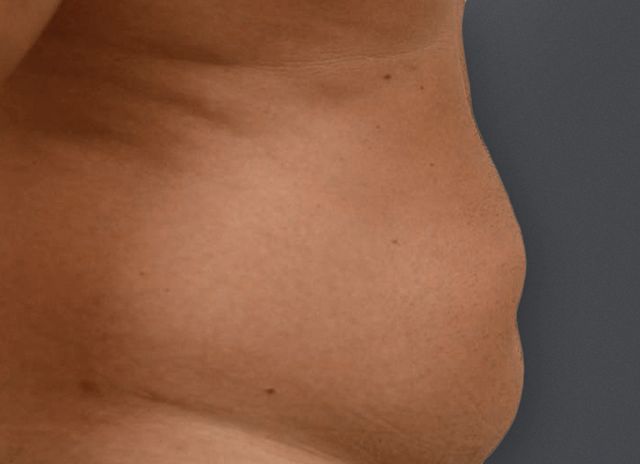 Avant Abdominoplastie 