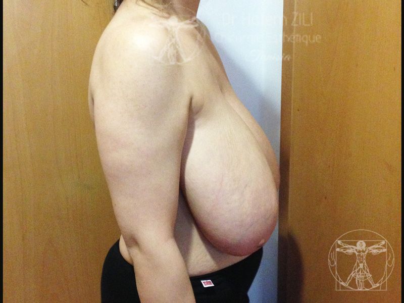 Cas 2  - Avant  Lifting