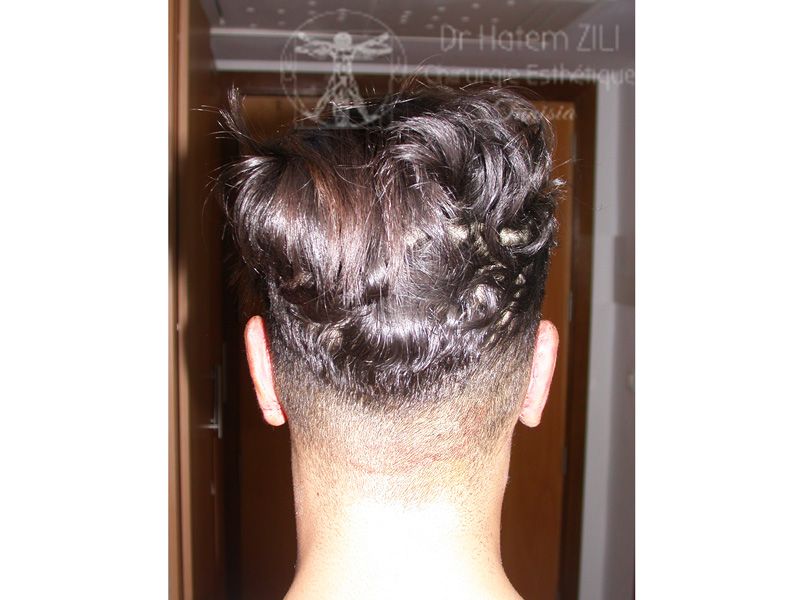 before-after_otoplastie_01_a-4fb1aaf8 Otoplastie - Chirurgie des oreilles