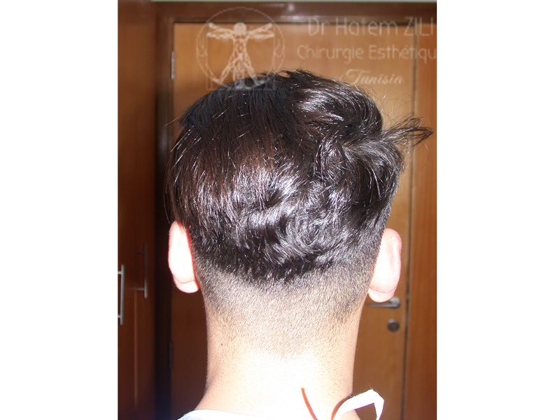 before-after_otoplastie_01_b-650d1a70 Otoplastie - Chirurgie des oreilles