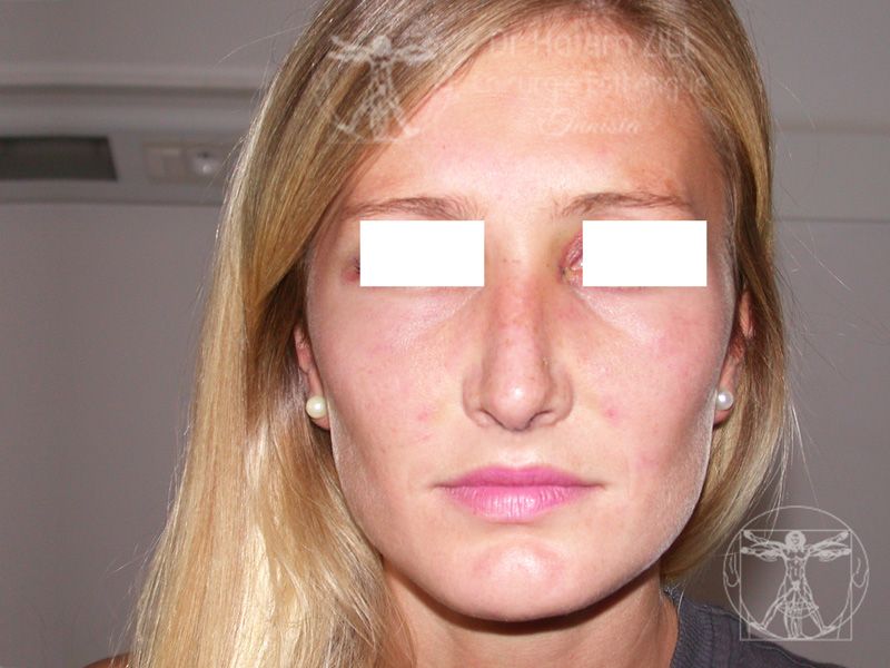 Rhinoplastie Après