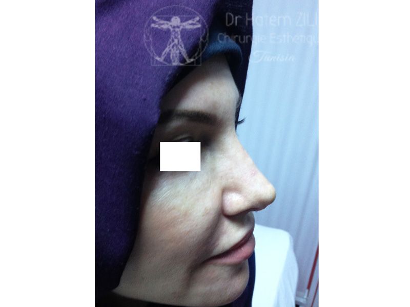 Rhinoplastie Après