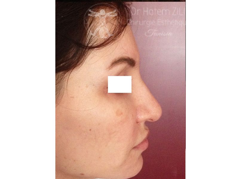 Rhinoplastie Avant intervention