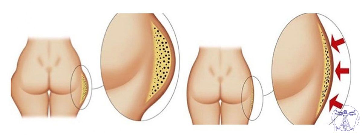 Liposuccion des hanches