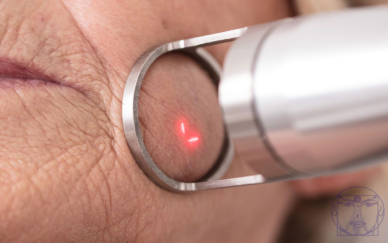 laser CO2 fractionné - traitement des rides