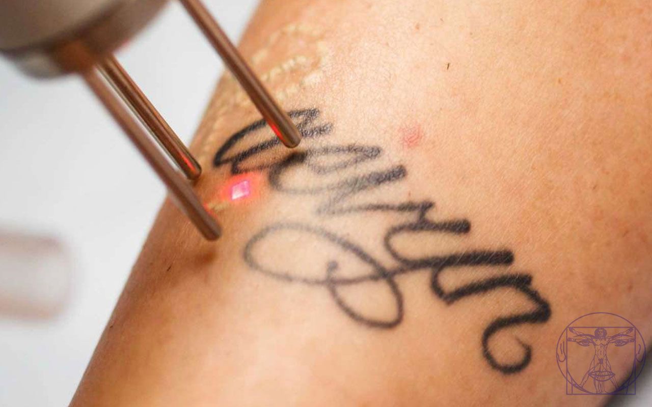 Détatouage au laser 