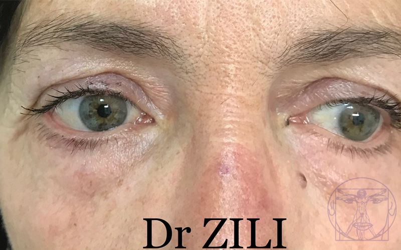 Blépharoplastie Après