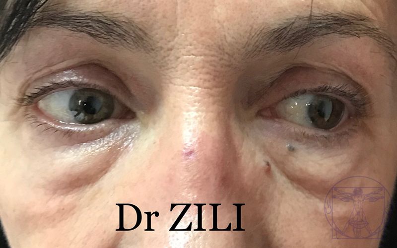 Blépharoplastie Avant